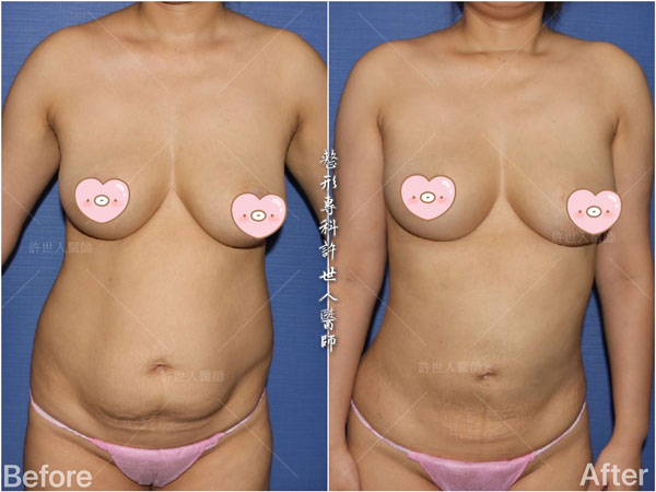 腰腹環抽,腹部抽脂 33 威塑抽脂案例– 腰腹環抽