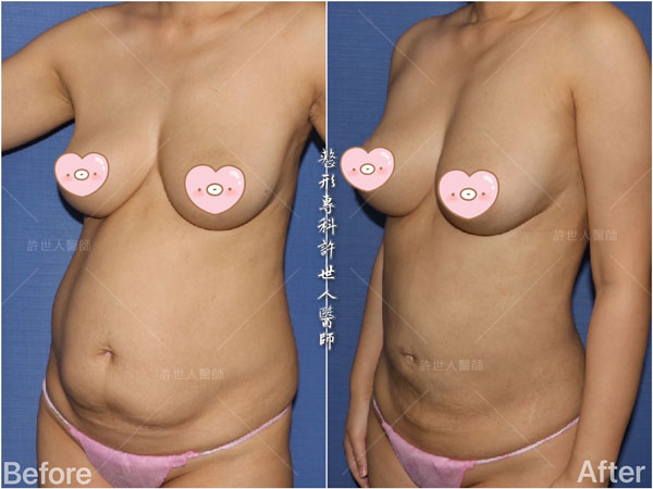 腰腹環抽,腹部抽脂 34 威塑抽脂案例– 腰腹環抽