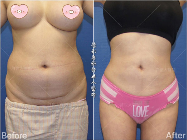 腰腹環抽,腹部抽脂 37 威塑抽脂案例– 腰腹環抽
