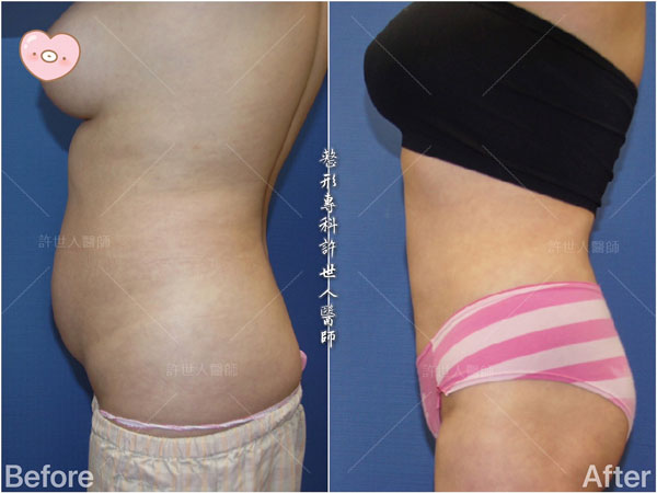 腰腹環抽,腹部抽脂 38 威塑抽脂案例– 腰腹環抽