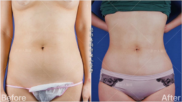 腰腹環抽,腹部抽脂 42 威塑抽脂案例– 腰腹環抽