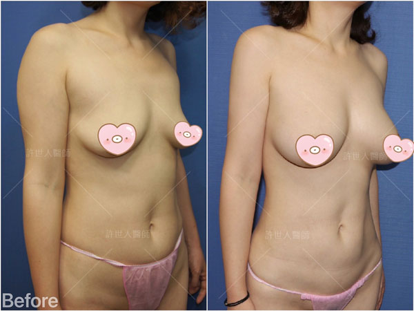 腰腹環抽,腹部抽脂 54 威塑抽脂體雕案例– 腰腹環抽+馬甲線雕塑