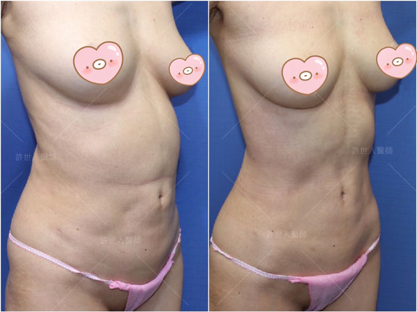 腰腹環抽,腹部抽脂 28 腹部抽脂,腰腹抽脂後凹凸不順重修 + 背部抽脂