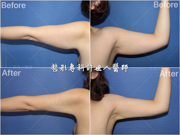 全身多處 21 全身威塑VASER抽脂體雕+自體脂肪隆乳