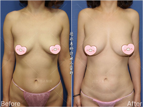 全身多處 17 全身威塑VASER抽脂體雕+自體脂肪隆乳