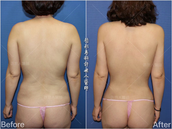 全身多處 20 全身威塑VASER抽脂體雕+自體脂肪隆乳