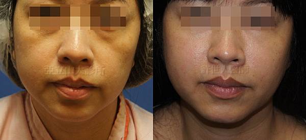 自體脂肪填補蘋果肌、淚溝、臉頰