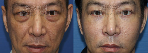 自體脂肪補臉,蘋果肌補脂,全臉補脂