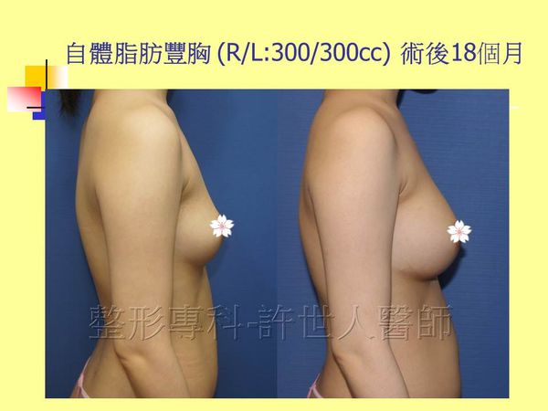 自體脂肪隆乳豐胸2022
