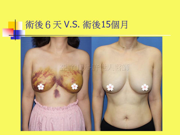 SIEF假體取出自體脂肪移植豐胸1A