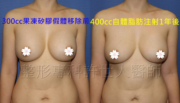 假體取出自體脂肪移植豐胸3A