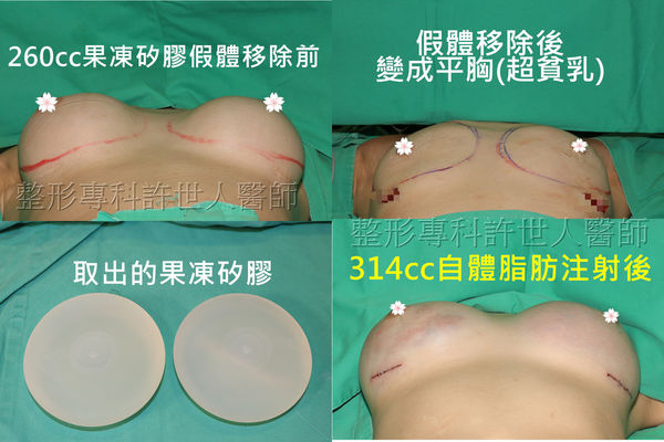 假體取出自體脂肪移植豐胸5D