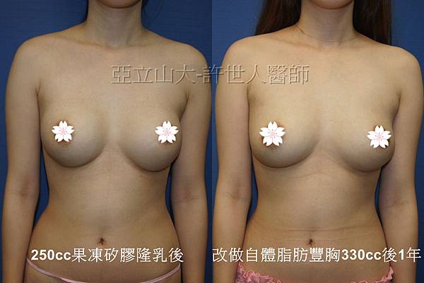 果凍矽膠取出改自體脂肪隆乳7E