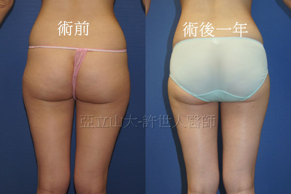 果凍矽膠取出改自體脂肪隆乳7d