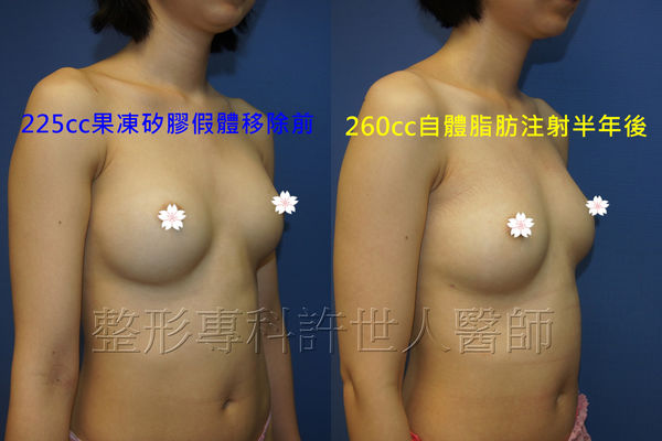 果凍矽膠取出改自體脂肪隆乳8B