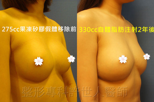 果凍矽膠義乳取出改自體脂肪隆乳9B