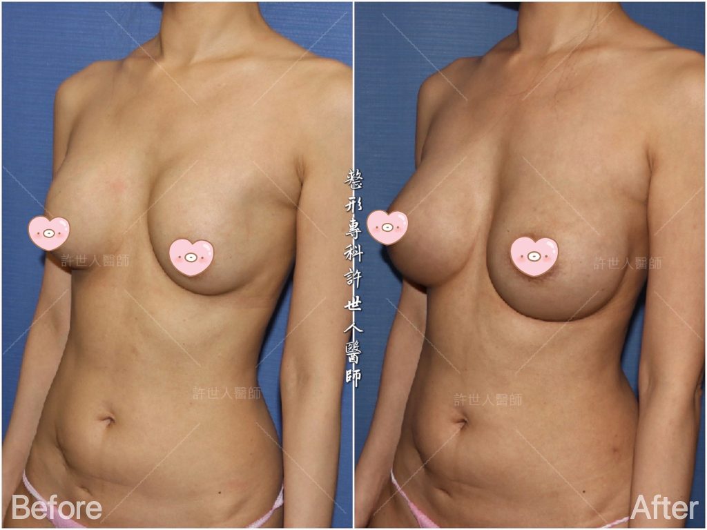 內視鏡矽膠假體隆乳 11 二次隆乳:2b莢膜攣縮的二次隆乳 複合式 脂肪加柔滴矽膠義乳