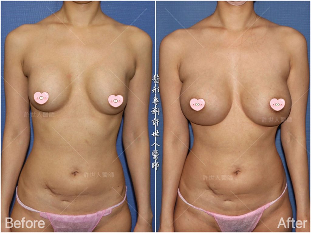 內視鏡矽膠假體隆乳 10 二次隆乳:莢膜攣縮的二次隆乳 複合式 脂肪加柔滴矽膠義乳 (1)
