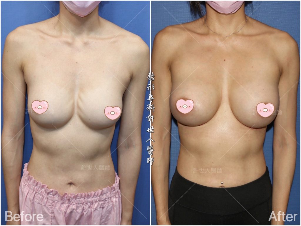 內視鏡矽膠假體隆乳 14 二次隆乳 案例4-水波紋的二次隆乳重修---柔滴矽膠義乳 (半筋半肉雙平面) 430cc