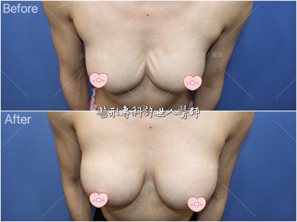 內視鏡矽膠假體隆乳 15 二次隆乳 案例4-水波紋的二次隆乳重修---柔滴矽膠義乳 (半筋半肉雙平面) 430cc
