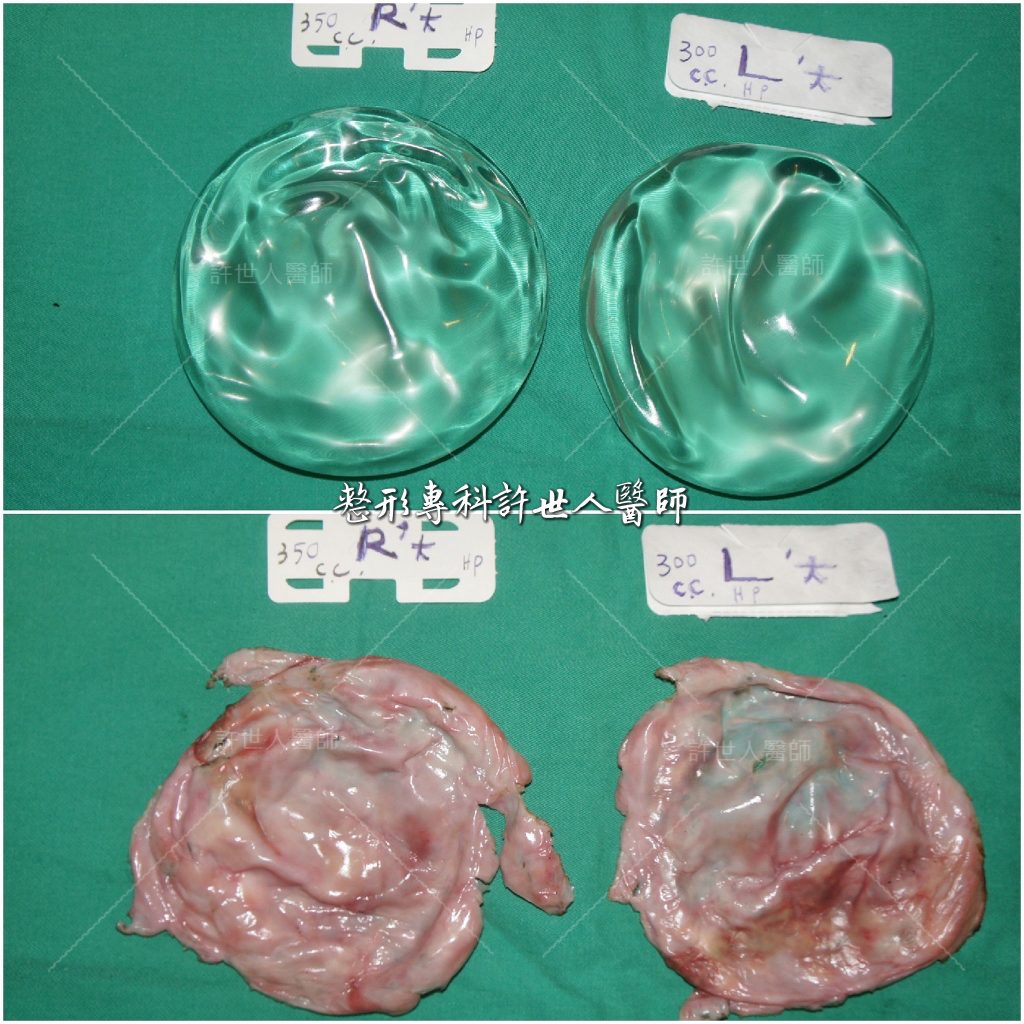 莢膜攣縮變形—莢膜切除+曼陀光滑面矽膠義乳( 半筋半肉雙平面) 275cc a 水波紋的二次隆乳 柔滴矽膠義乳 (1) 4 莢膜攣縮的二次隆乳曼陀光滑面矽膠義乳4