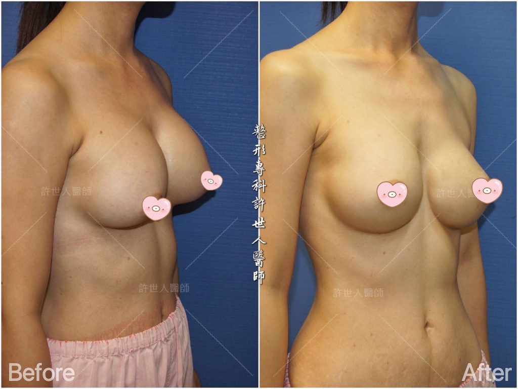 內視鏡矽膠假體隆乳 23 二次隆乳案例6:莢膜攣縮變形---莢膜切除+曼陀光滑面矽膠義乳( 半筋半肉雙平面) 275cc