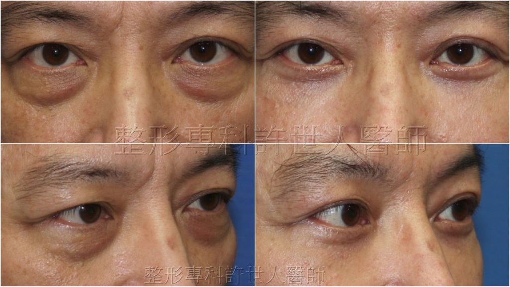 外開式六合一眼袋脂肪移位手術