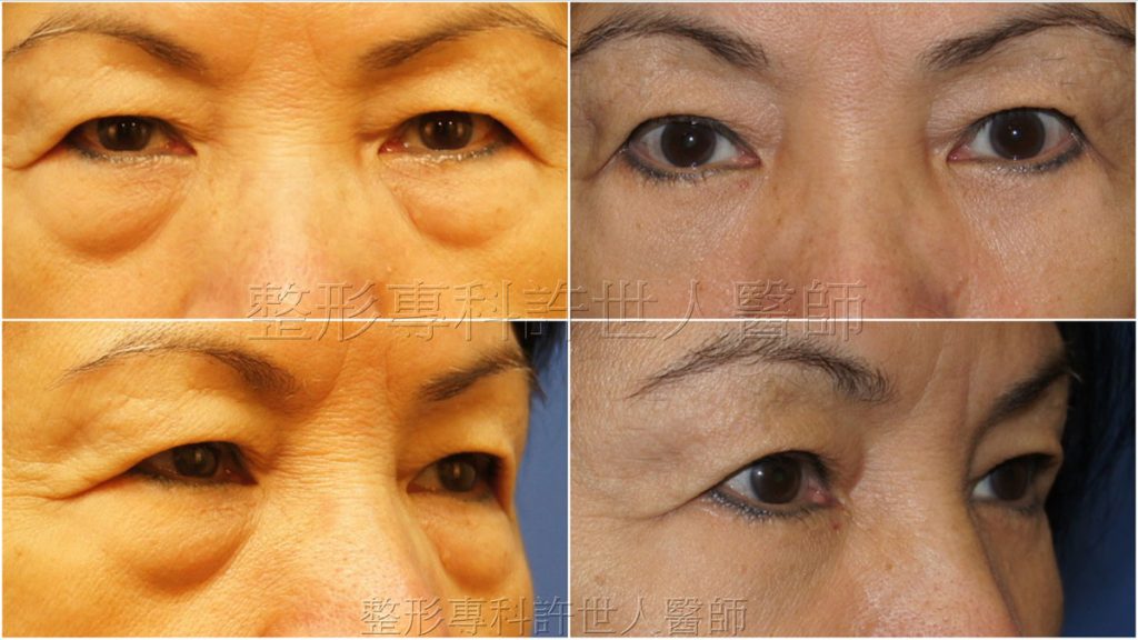 外開式六合一眼袋脂肪移位手術