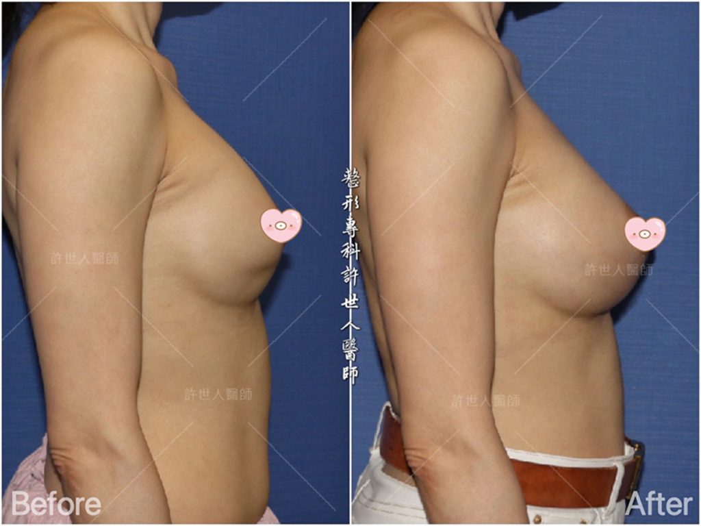 內視鏡矽膠假體隆乳 20 二次隆乳重修:雙層奶和矽膠義乳破裂的二次隆乳重修+清除莢膜 (