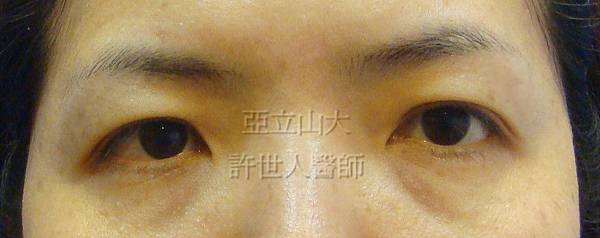眼袋手術 提眉手術術前