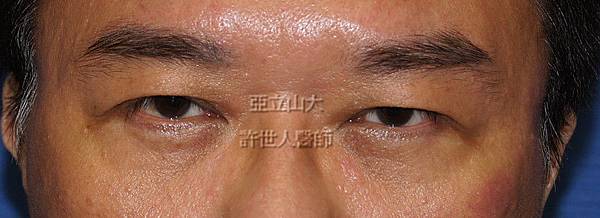 內視鏡五爪鈎前額拉皮提眉術 9 1377487785 3514658014 n