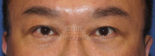 內視鏡五爪鈎前額拉皮提眉術 10 1377487785 3623254921 n