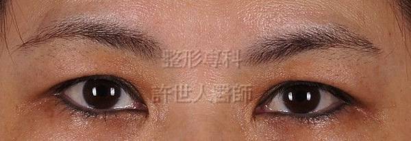 內視鏡五爪鈎前額拉皮提眉術 5 術前:提眉手術+眼袋手術(內視鏡前額拉皮,內視鏡提眉,許世人醫師案例)