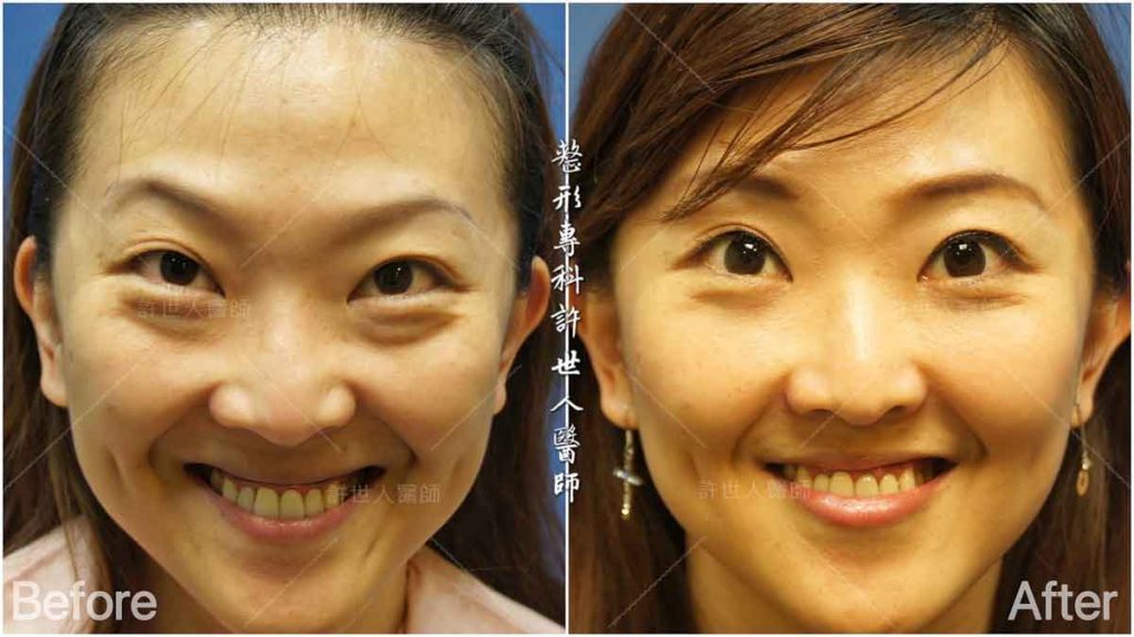 眼袋內開脂肪移位手術 術前術後對照圖 許世人醫師案例分享