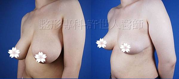 縮乳提乳案例(棒棒糖式短疤縮乳提乳手術)
