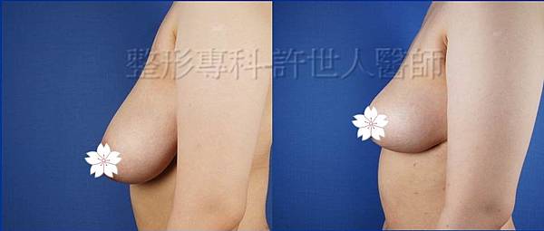 縮乳提乳術案例_(棒棒糖式短疤縮乳提乳手術)