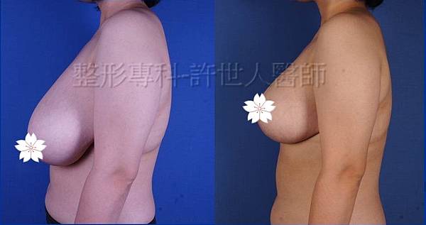 縮乳提乳案例(棒棒糖式短疤縮乳提乳手術),許世人醫師案例