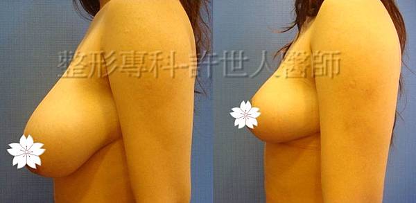 縮乳提乳案例(棒棒糖式短疤縮乳提乳手術),許世人醫師案例