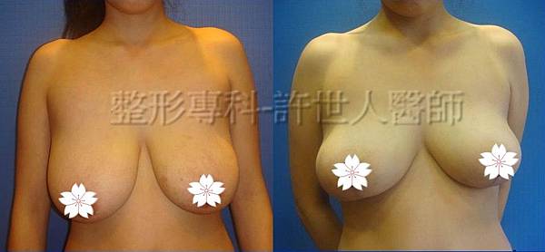 縮乳提乳案例(棒棒糖式短疤縮乳提乳手術),許世人醫師案例