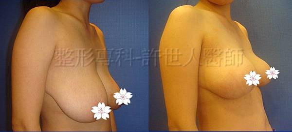 縮乳提乳案例(棒棒糖式短疤縮乳提乳手術),許世人醫師案例
