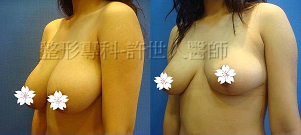 縮乳提乳案例(棒棒糖式短疤縮乳提乳手術),許世人醫師案例