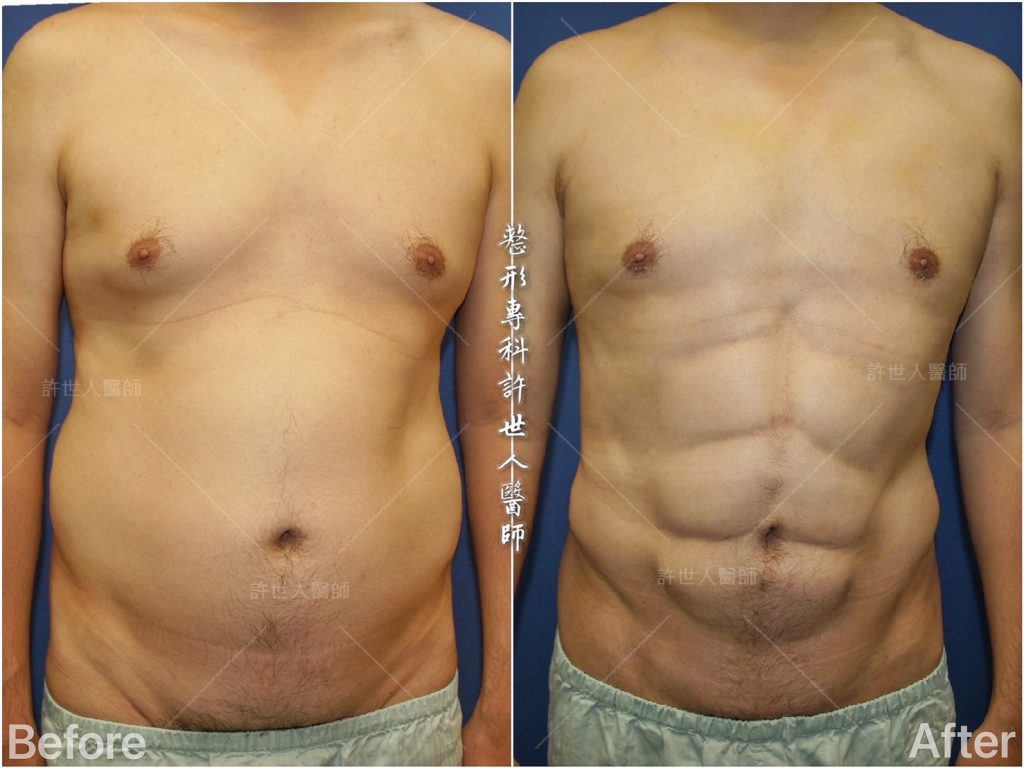 威塑VASER抽脂體雕) 腰腹環抽部抽脂+ 六塊肌 人魚線雕塑 威塑VASER抽脂體雕 腰腹環抽部抽脂 六塊肌 人魚線雕塑 1