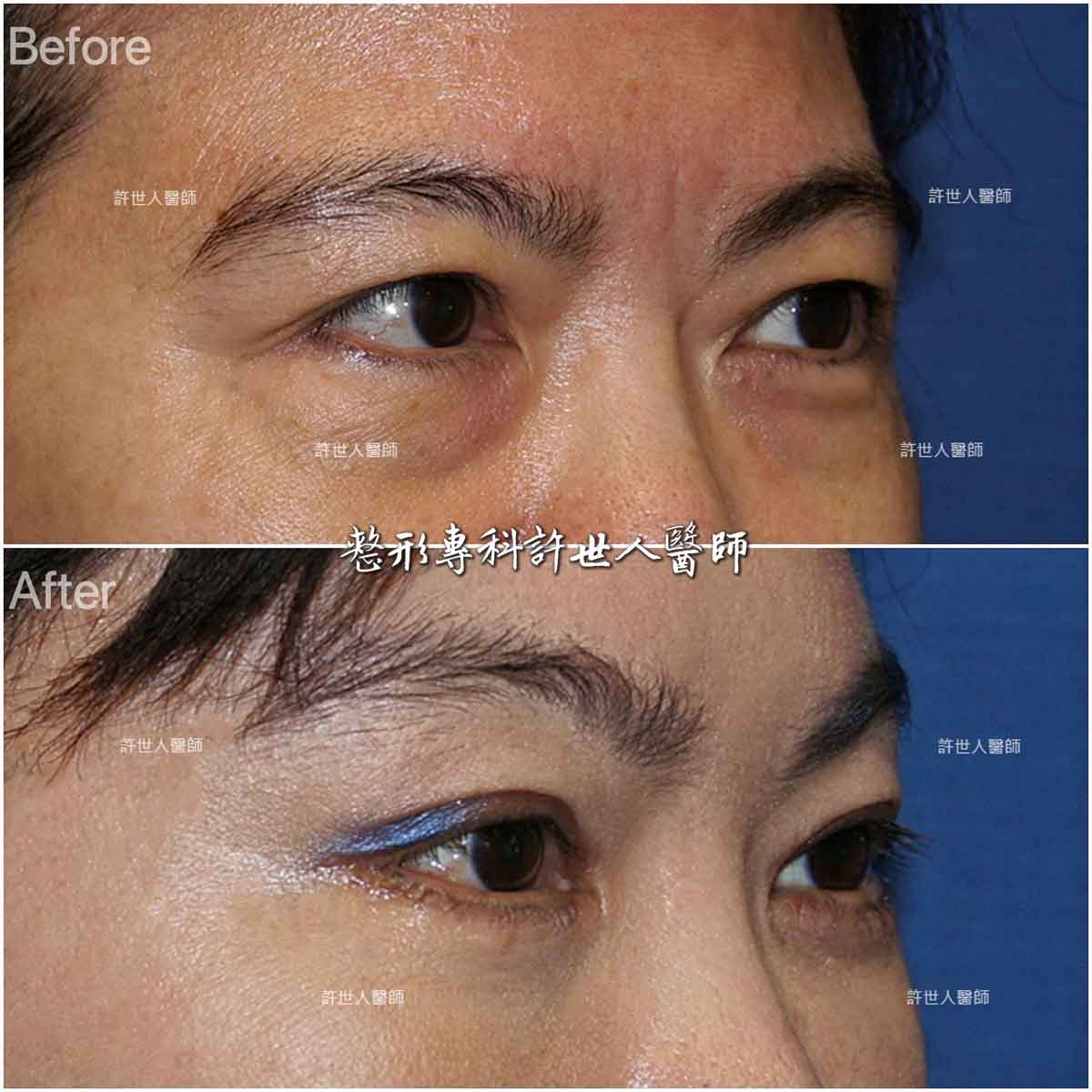 內視鏡五爪鈎前額拉皮提眉術+眼袋外開脂肪移位填淚溝手術