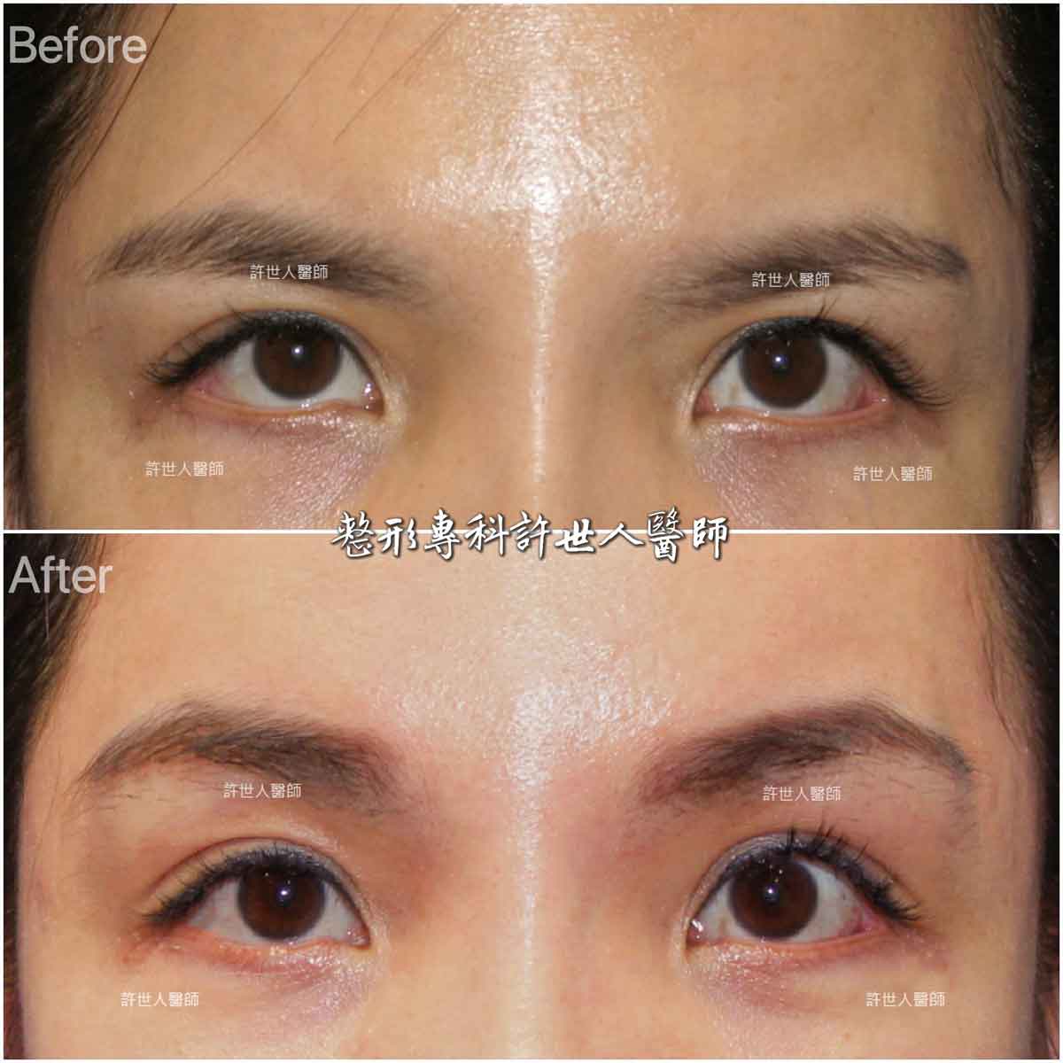 10A-內視鏡五爪勾提眉手術 內視鏡五爪鈎前額拉皮提眉術許世人醫師案例分享