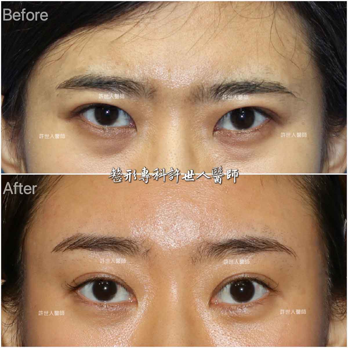 內視鏡五爪鈎前額拉皮前額拉皮提眉＋內開眼袋脂肪移位手術許世人醫師案例分享