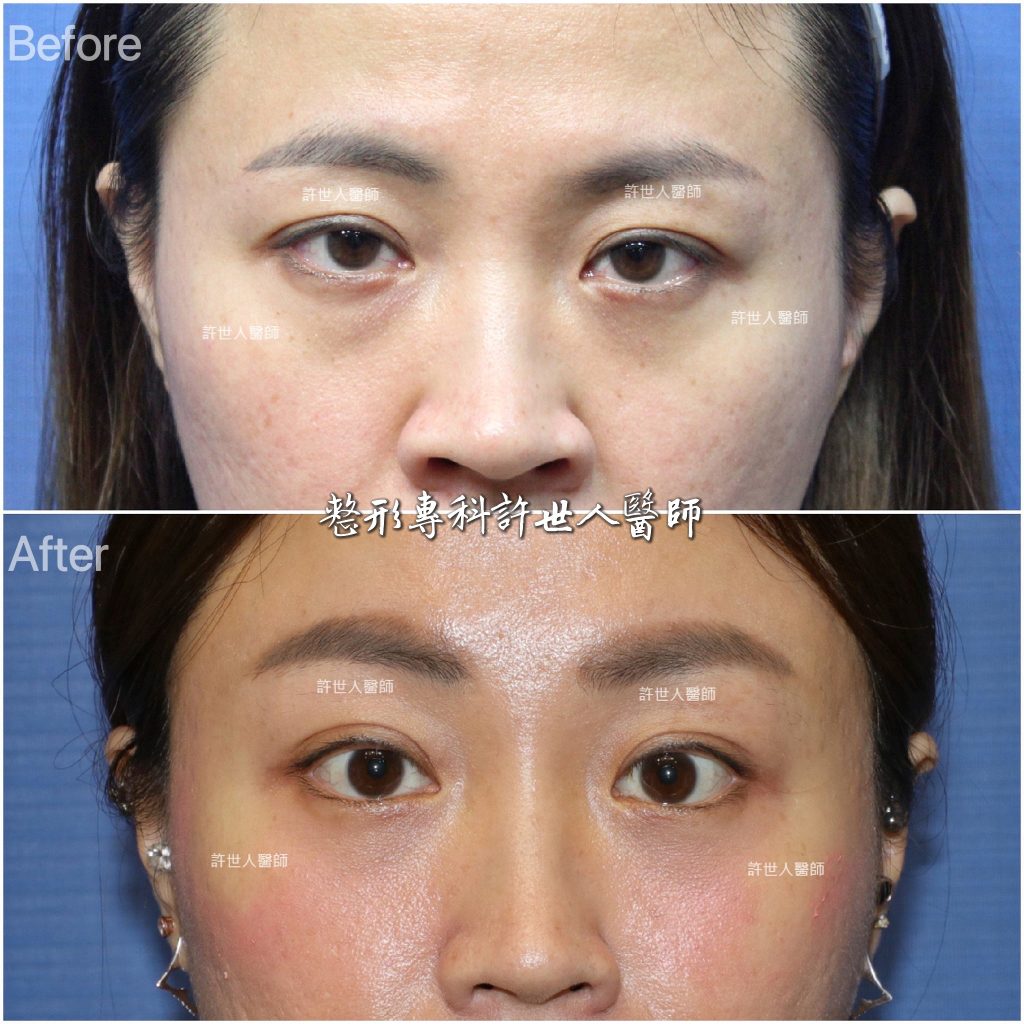 內視鏡五爪鈎提眉＋縮鼻翼手術  許世人醫師案例分享