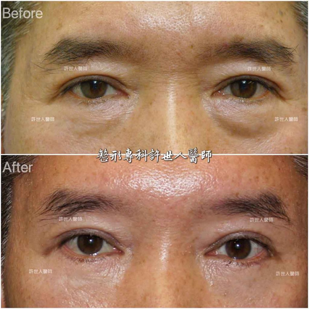 內視鏡五爪鈎前額拉皮提眉術+眼袋外開脂肪移位填淚溝手術許世人醫師案例分享