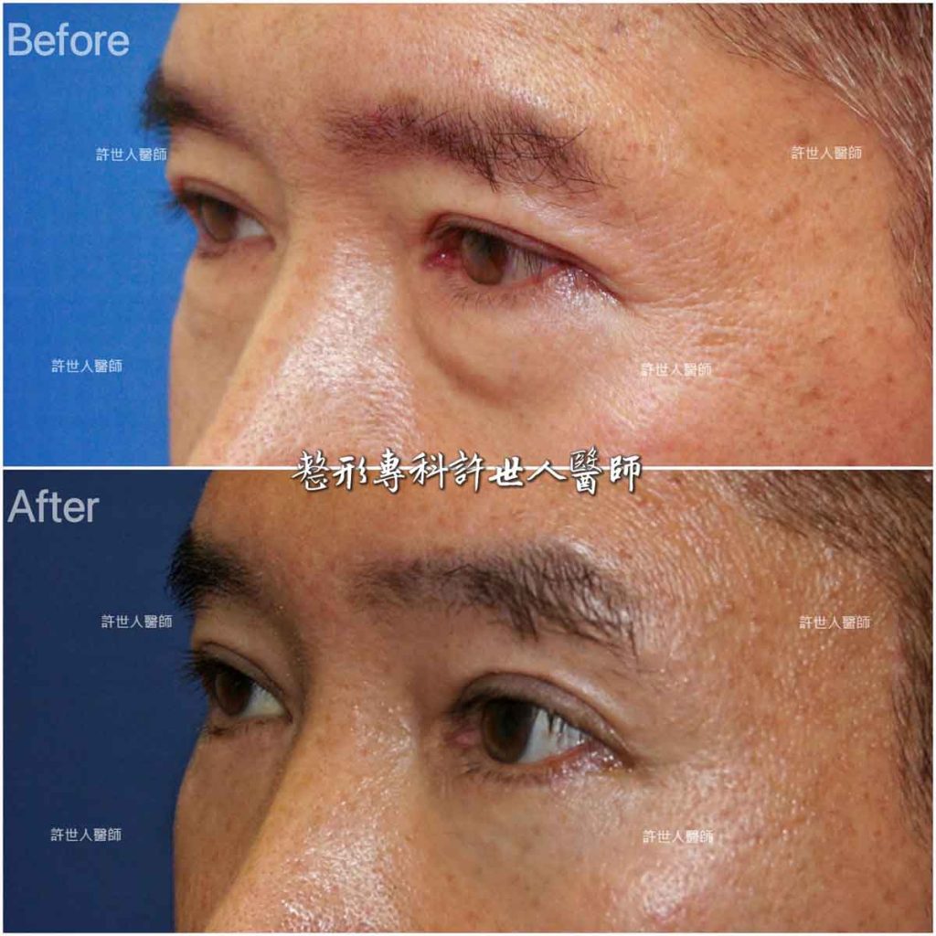 內視鏡五爪鈎前額拉皮提眉術+眼袋外開脂肪移位填淚溝手術許世人醫師案例分享