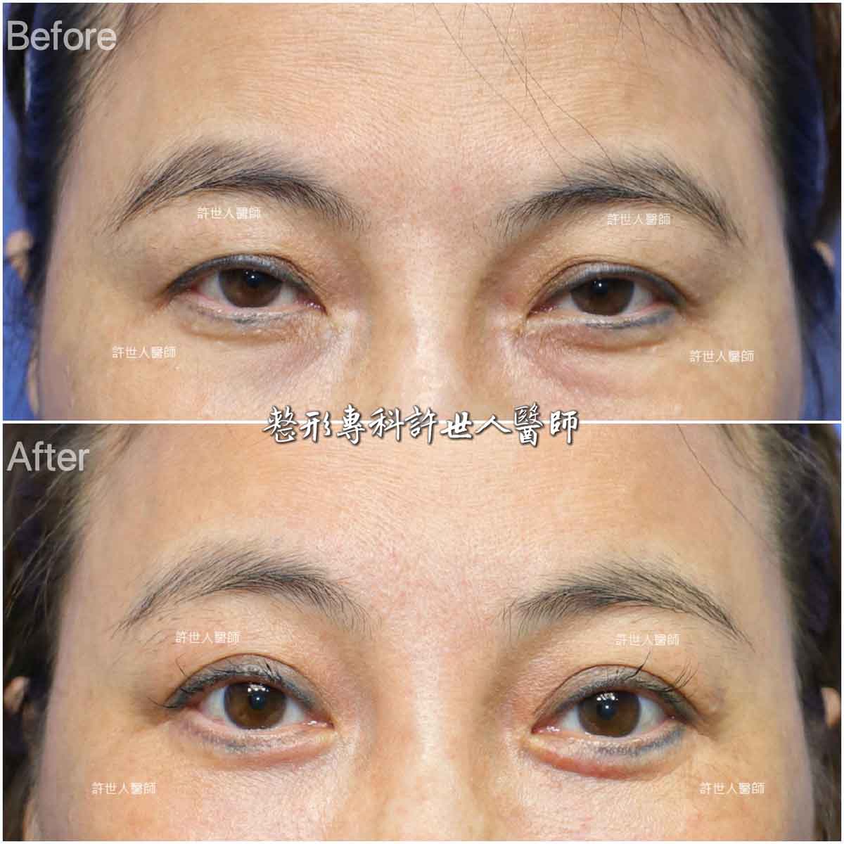 內視鏡五爪鈎前額拉皮提眉術+眼袋外開脂肪移位填淚溝手術