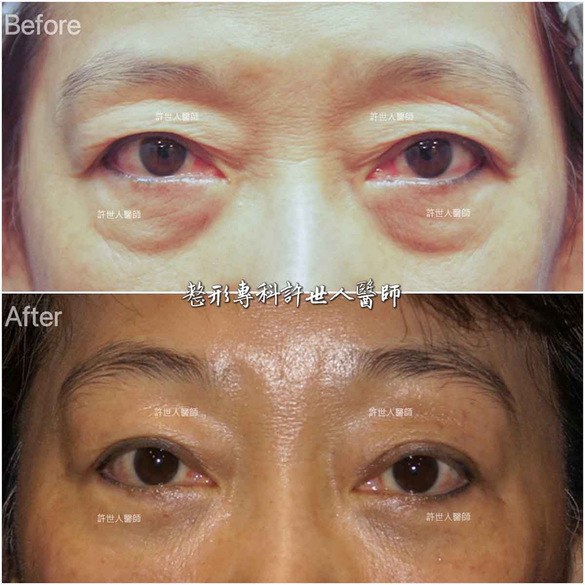 內視鏡五爪鈎前額拉皮前額拉皮提眉＋內開眼袋脂肪移位手術許世人醫師案例分享